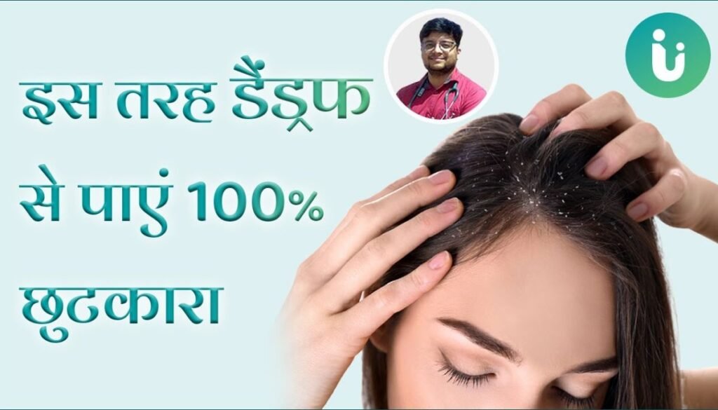 Dandruff Causes And Treatment: 