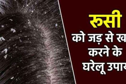 Dandruff Causes And Treatment: घरेलू नुस्खे से करें डैंड्रफ का इलाज, मिलेगा रहता