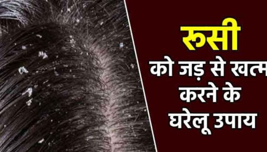 Dandruff Causes And Treatment: घरेलू नुस्खे से करें डैंड्रफ का इलाज, मिलेगा रहता